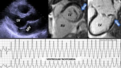 $10.2 Million NIH Grant to Explore the Early Signs of Arrhythmic Mitral Valve Prolapse