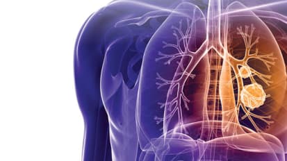 One-Day Lung Cancer Clinic Improves Outcomes and Cuts Costs