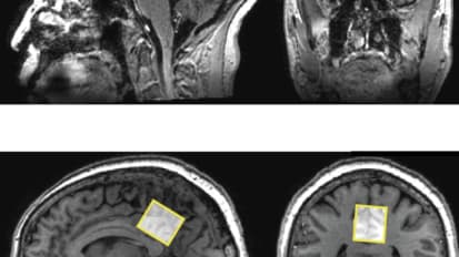 Measuring Differences in Brain Chemicals in People with Mild Memory Problems