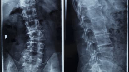 Shatter the Myth: Treatment Options Do Exist for Adults Suffering from Scoliosis