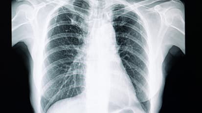 New Findings on Idiopathic Pulmonary Fibrosis