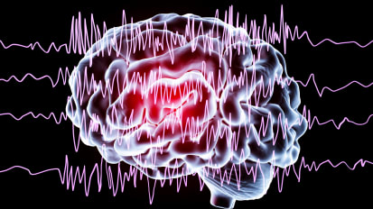 New Tools Map Seizures, Improve Epilepsy Treatment