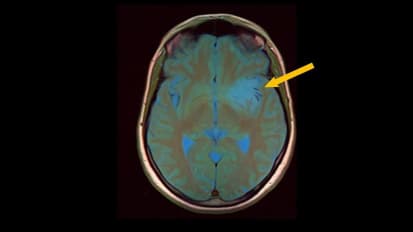 Johns Hopkins Medicine-Led Study Shows Mutations May Cause Brain Tumors to Resist Therapy