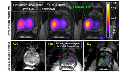 Novel Metabolic Imaging Method Detects Prostate Cancer Aggressiveness