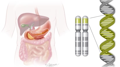 Genetic Testing Reveals Important Clues in Unexplained Cases of Pancreatitis