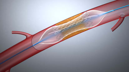 Expanded Options for Treating Peripheral Artery Disease