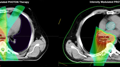 Proton Therapy for the Patient with Complex Presentation