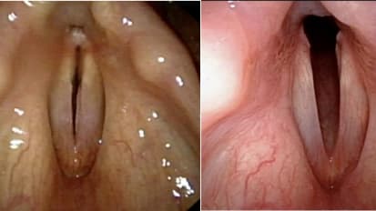 Airway Injuries and Tracheotomies After COVID-19