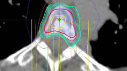 Is Earlier Better? PROMISSeD Trial Explores Early Radiation Therapy as a Prophylactic Treatment for Patients With High-risk Spine Metastases