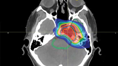 Proton Therapy FAQs for CNS Cancer