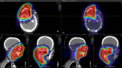 Proton Therapy Radiation Benefits Woman with Rhabdomyosarcoma