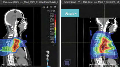 Proton Therapy Case Study—Lung Cancer