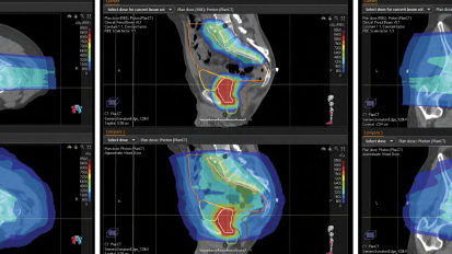 Proton Therapy Case Study – Prostate Cancer