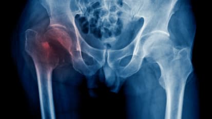 Hip Fractures May be an Early Sign of Alzheimer’s Disease for Older People