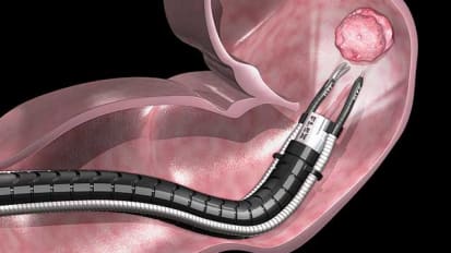 Johns Hopkins Among First to Offer Flexible Robotic Endoscopy