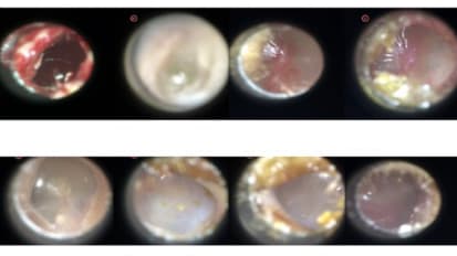 A Smart Otoscope to Better Diagnose Ear Infections