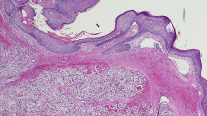 Shedding Light on the “Trickle-Down” Effect of Mutated Genes in Kidney Cancer