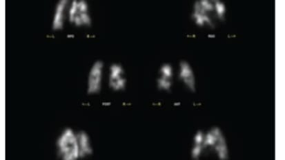 Advanced Diagnosis and Therapy for Chronic Thromboembolic Pulmonary Hypertension (CTEPH) in 69-year-old Patient