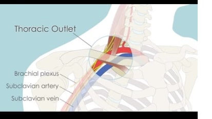 Calculating Thoracic Outlet Surgery Success