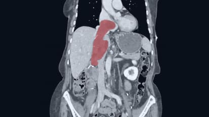 Johns Hopkins Surgeons Perform Institution’s First Ante Situm Liver Resection