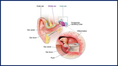 Research Story Tip: Clinicians Use Artificial Intelligence to Diagnose Ear Infections More Accurately