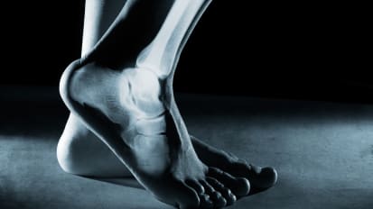 Minimally Invasive Foot & Ankle Surgery at Penn Orthopaedics