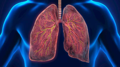 The Potential for Bronchoscopic Interventions in Chronic Bronchitis