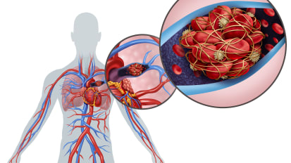 Standardizing the Pulmonary Embolism care with Pulmonary Embolism Response Teams (PERT)