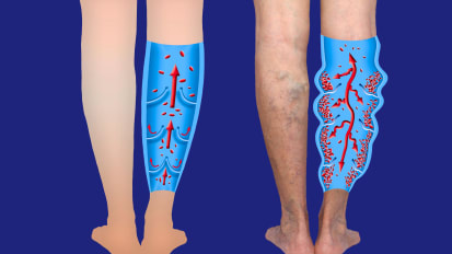 11th Annual Vascular Disease Update : FRIDAY SESSION TWO | Peripheral Artery Disease and Limb Salvage 