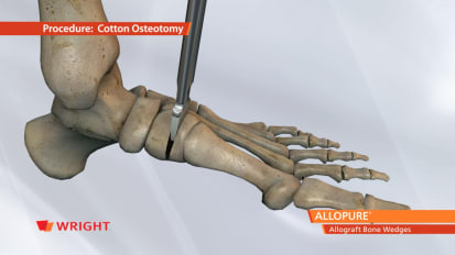 ALLOPURE™ Allograft Bone Wedges Animation. Specific for Evans and Cotton Osteotomies [009117]