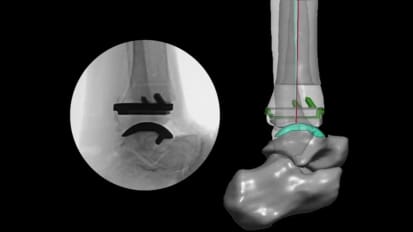 PROPHECY™ INFINITY™ Preoperative Navigation System Cadaveric Video [011422 ]