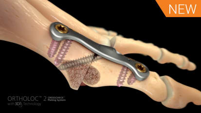 1st MTP Fusion Animation featuring ORTHOLOC™ 2 CROSSCHECK™ [016676A]