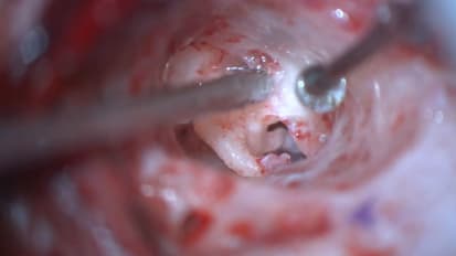Mount Sinai Otolaryngology Surgical Series: Microtia Atresia Ear Canal Reconstruction