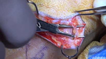 Mount Sinai Otolaryngology Surgical Series: Branchial Cleft Cyst Removal