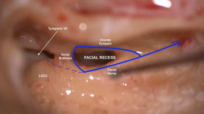 Mount Sinai Otolaryngology Surgical Series: Cochlear Implant Surgery