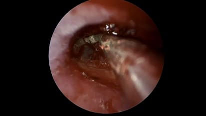 Mount Sinai Otolaryngology Surgical Series: Ear Drum Repair (Tympanoplasty) With Lateral Graft