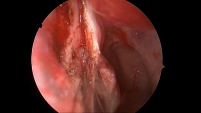 Mount Sinai Otolaryngology Surgical Series: Surgery for Chronic Rhinitis/Runny Nose: SP3