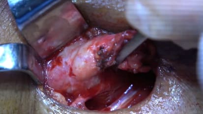 Mount Sinai Otolaryngology Surgical Series: Submandibular Gland Excision