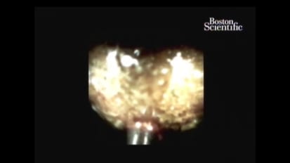 Electrohydraulic Lithotripsy for Large Common Bile Duct Stones, by Douglas G. Adler, M.D.