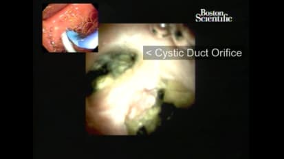 Diagnosing and Treating Type II Mirizzi Syndrome using the SpyGlass™ DS System, by John T. Cunningham, MD 