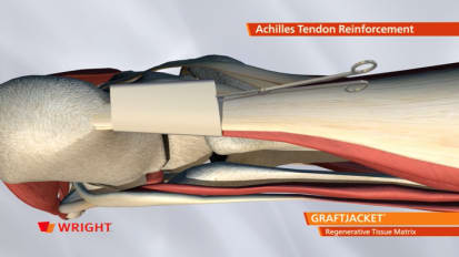 GRAFTJACKET™ Animation Combo - Achilles, Fatpad (plantar), Lateral Ankle, Post Tib [009795]