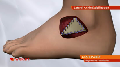 GRAFTJACKET™ Regenerative Tissue Matrix Lateral Ankle Stabilization Animation 009130 A_27-Nov-2013