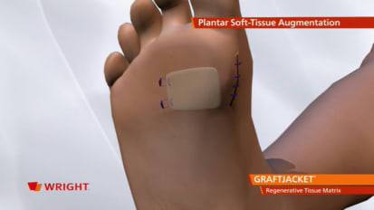 GRAFTJACKET™ Regenerative Tissue Matrix Plantar Animation [009127]