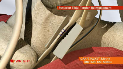 GRAFTJACKET™ Regenerative Tissue Matrix Posterior Tibial Tendon Reinforcement Animation [009129] 