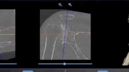 Shoulder Arthroplasty featuring PERFORM+: Case Planning of Posterior-Augmented AEQUALIS™ PERFORM™ + Implant for the Treatment of B2-type Glenoid Deformity - Eric Black, MD [CAW-8495] 