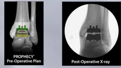 Total Ankle System Animation featuring PROPHECY® INFINITY® [010378]