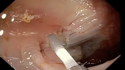 Case Study Evaluating the Resolution Clip&trade; vs. the Resolution 360&trade; Clip for Defect Closure in the Colon, by Stephen Kim, MD