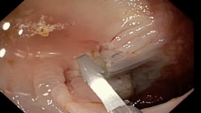 Case Study Evaluating the Resolution Clip vs. the Resolution 360 Clip for Defect Closure in the Colon, by Stephen Kim, MD