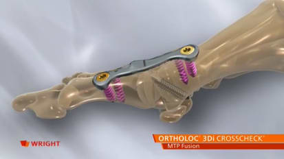 ORTHOLOC™ 3Di CROSSCHECK™ MTP Fusion Animation [013805]