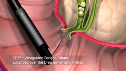 Dilation Assisted Stone Extraction (DASE) Procedural Animation